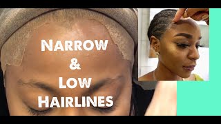 Small Forehead Application | How To Fix Low And Narrow Hairline Problems #Lowhairline #Lacefront