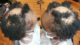 She Was Extremely Transformed & She Was So Happy, Alopecia Hair Makeover, How To Cover Bald Spots