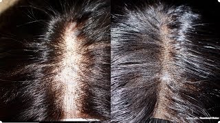 How To Fix Balding Or Overplucked Lace Closure