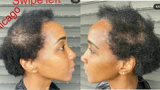 This Is One Epic & Flawless Transformation You Don'T Wanna Miss, Extreme Alopecia Hair Makeover