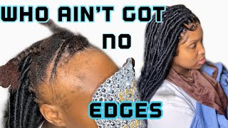 Lace Frontal With Braids | For Alopecia | No Wig
