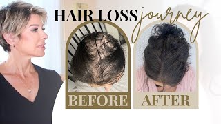 Hair Loss In Women: Dr. Approved Treatments, Shampoos & Thin Hair Hairstyles Tips | Dominique Sachse