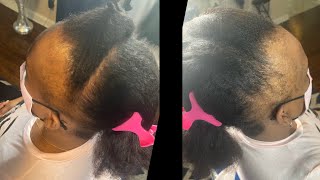No Edges?? Alopecia? You Can Still Get Braids!  Knotless Braids On Frontal | Eve Hair