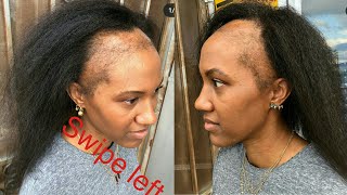 Over A Decade Of Damage & Lost Confidence, Her Transformation Will Totally Shock You, Alopecia Hair