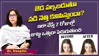 నడి నేతి కనిపిస్తుందా | Hair Loss Treatment For Women In Telugu | Dr Deepthi | Health Tips In Telugu