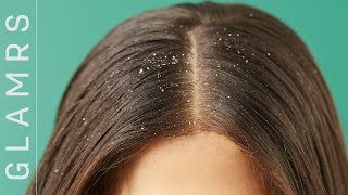 How To Get Rid Of Dandruff | The Ultimate Hair Care Routine For Dandruff And Itchy Scalp