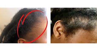 Grow Back Your Edges Faster With This 1 Simple Tip!