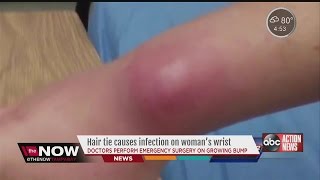 Hair-Tie Causes Infection On Woman’S Wrist
