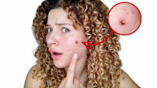 Are Your Curly Hair Products Causing Acne? (Causes, Symptoms And Solutions)