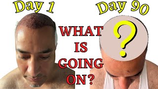 3 Months In Results Of Fue Hair Transplant In Turkey /What Happened To His Forehead ?