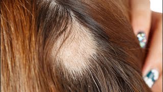 Trichotillomania | Hair Pulling Hair Care