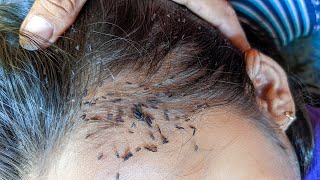 How To Moving Out All Lice From Black Hair - Care Head A Way From Lice  [4]