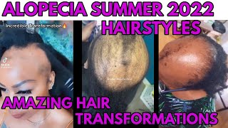 Beautiful Alopecia Hairstyles For Summer 2022