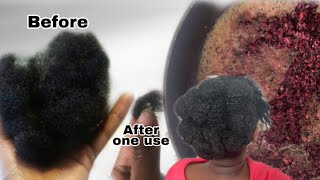 This Treatment Will Stop Hair Breakages And Grow Your Hair 10 Times Faster | How To Treat Balding