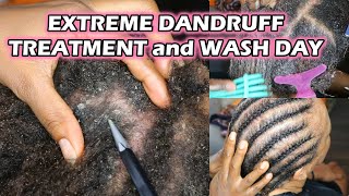 Extreme Dandruff Treatment | Seborrheic Dermatitis | Natural Hair Wash Day Discoveringnatural