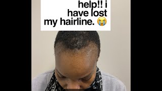 Traction Alopecia - The Struggle Of Many Black Girls: No Hairline, No Edges | #Hairrestoration Ep.2