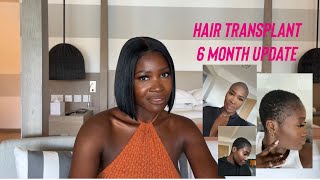Hair Transplant 6 Months Update || More Growth| Prp Treatments