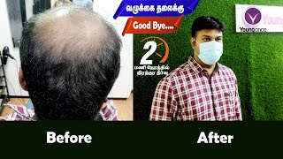 Hair Replacement | Hair Clip | Chennai | Nagercoil | Salem | Coimbatore | Tamilnadu : 8110072863