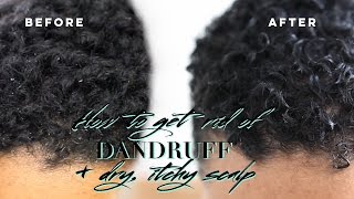 How I Got Rid Of Dandruff & Dry, Itchy Scalp • Scalp Massaging Brush