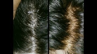 How To: Bleach Knot And Prevent Shedding On Lace Closure