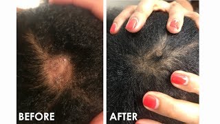 How I Grew Out My Bald Spot In Just 2 Weeks!  Video & Photos Included! (Before & After)