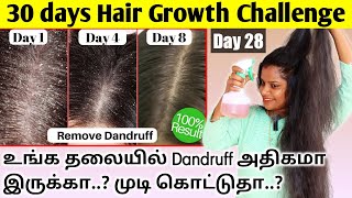 காரணம் இல்லாமல் முடி கொட்டுதா..? Hair Growth Booster Easy Spray To Scalp / Faster Hair Growth