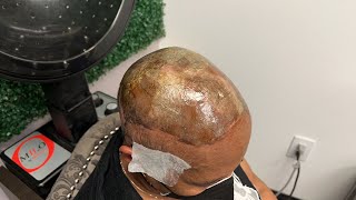 Her Hair Won’T Grow Anymore| Alopecia Hair Weave| Alopecia Scarring