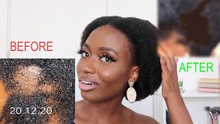 How I Grew My Bald Spot On My 4C Natural Hair In 2 Months With Pictures