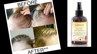 How To Use: Grow New Hair Treatment + Does It Work?  | My Real Results + 20% Off
