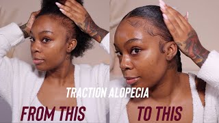 Beginner Friendly: How To Achieve Braided Ponytail With Traction Alopecia 
| Yvonne Queen |
