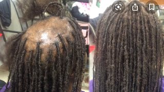 How To Grow Your Hair Back From Alopecia When You Have Locs, Sister Locs, Brother Locs