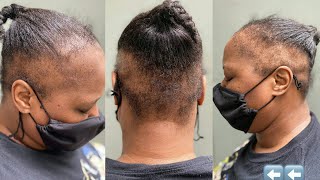 Her Dermatologist Couldn'T Help, So She Came To Me, Extreme Alopecia Hair Makeover, Hair Loss
