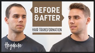 Hair Loss At 20 - The Solution For Instant Full Hair !