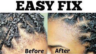 How To | Easy Fix Hairline/Edges Box Braids & Twists