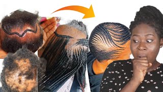 Dont Watch This |Alopecia Braiding Hairstyles Transformation,,,|Cute Braiding Hairstyles