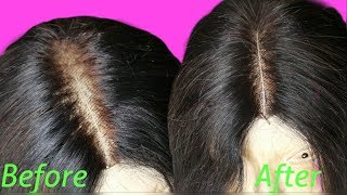 How To Fix Bald Over Plucked Lace Frontal And Closure  In 4 Steps