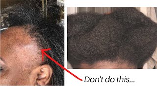 Wearing Wigs Can Damage Your Edges And Cause Bald Patches. Don'T Do This...