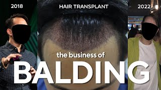 The Dreadful Business Of Balding & Hair Loss