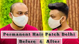 Permanent Hair Patch Delhi | Permanent Hair Patch Delhi Price | Call Us 9650914665 | Permanent Hair