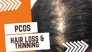 Hair Loss From Pcos| Pcos Hair Thinning | How To Care For Hair Pcos | Polycystic Ovary Syndrome