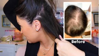 How I Grew My Hair Back Naturally! My Hair Loss Journey (Before And After)