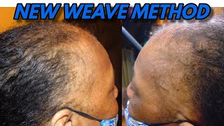 How To: Alopecia Hair Loss Method Detailed To "Cover Bald Edges & Areas"