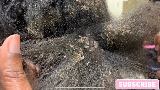  2 Months After Taking Down A Protective Style On My Natural Hair| Extreme Dandruff| Psoriasis