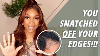 Top 10 Tips To Avoid Hair Loss When Wearing Wigs | This Is Why Your Edges Are Disappearing!