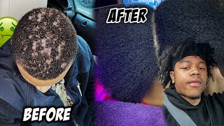 How I Reversed Hair Loss In The Military & How To Prevent It