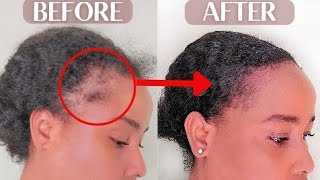 Grow Back Your Hairline / Edges  Fast.  In Just 2 Months!