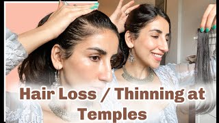 Hair Thinning At Temples Or Receding Hair Line Cover Up With Nish Hair