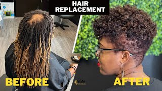 Her Dreadlocks Were Making Her Bald Faster| Hair Replacement For Women| Female Pattern Baldness Fix