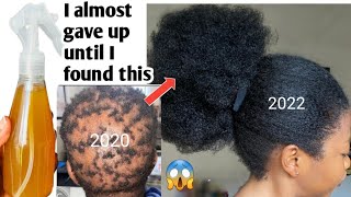 No Hair Will Fall Out Again/Speed Up Your Hair Growth/Treat Alopecia/Do Not Wash It Out