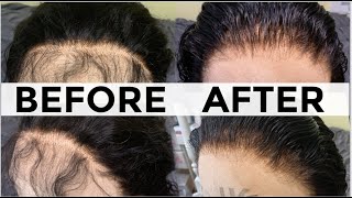How To Bleach Knots & Pluck Lace Frontal | Detailed Talk Through Video | Amazon Beauty Forever Hair